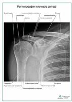 Рентгенография плечевого сустава