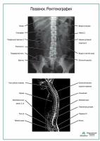 Позвонок. Рентгенография плакат