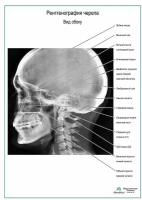 Рентгенография черепа. Вид сбоку плакат
