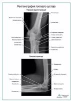 Рентгенография локтевого сустава плакат